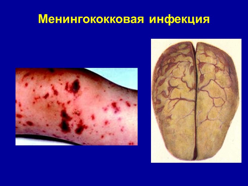 Менингококковая инфекция